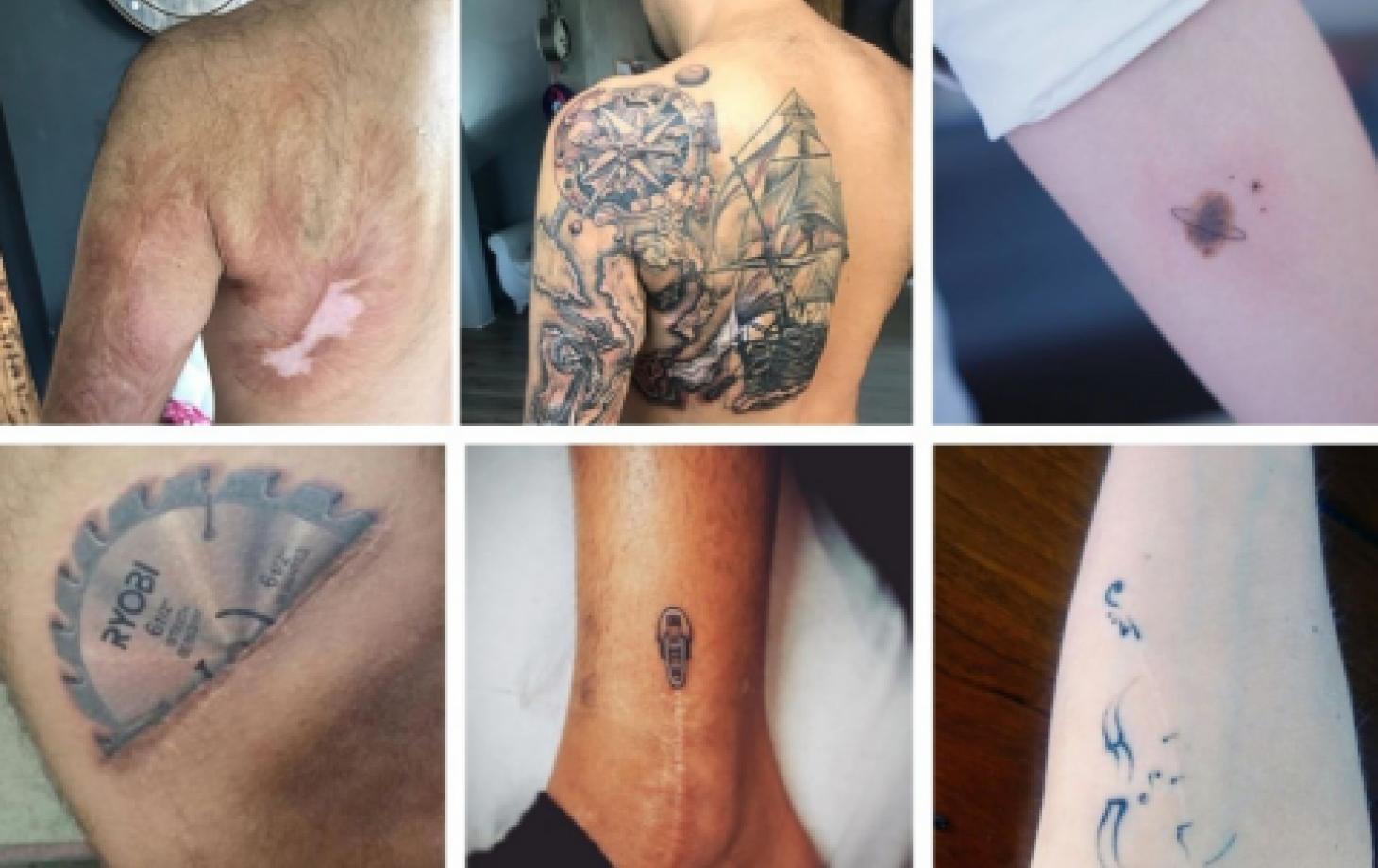 Татуировки на шрамах и других поврежденных кожных покровах